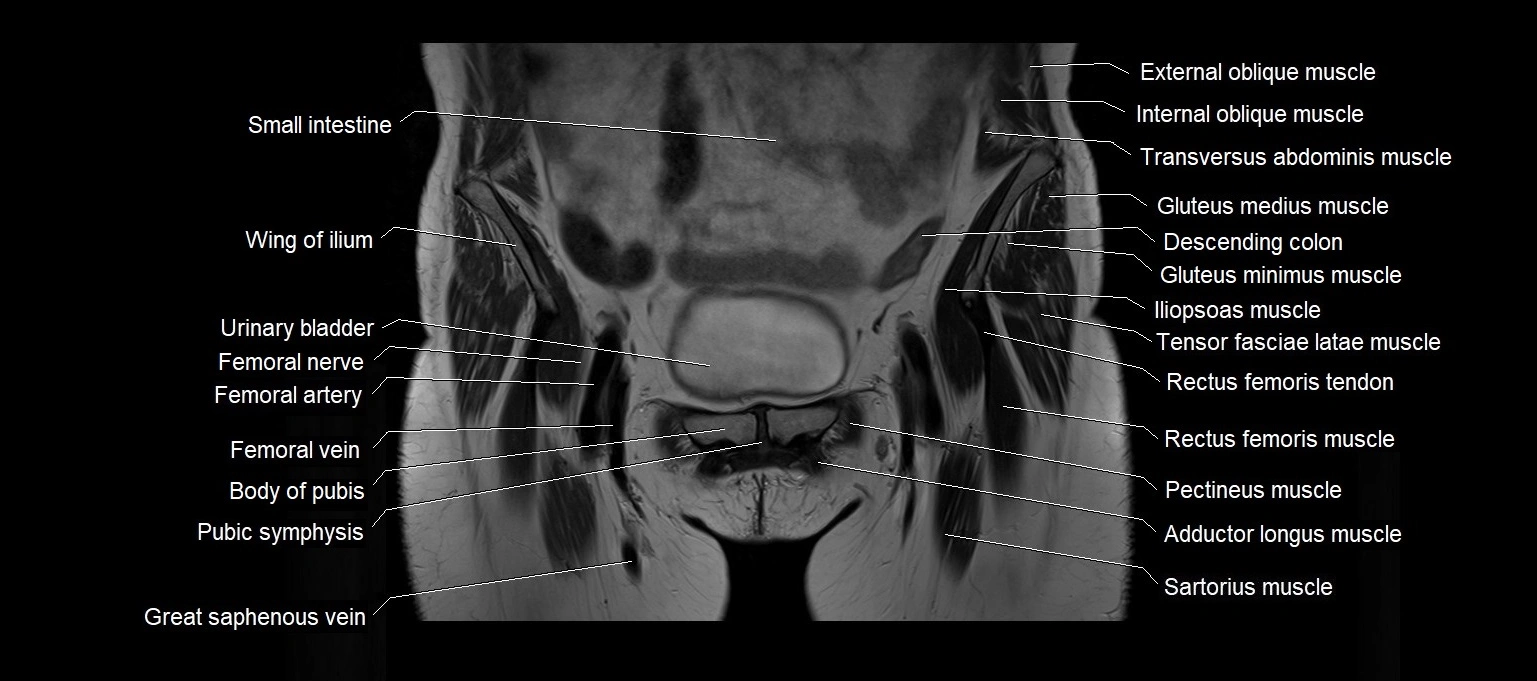 MRI 3T pelvis coronal cross section anatomy image 5.webp